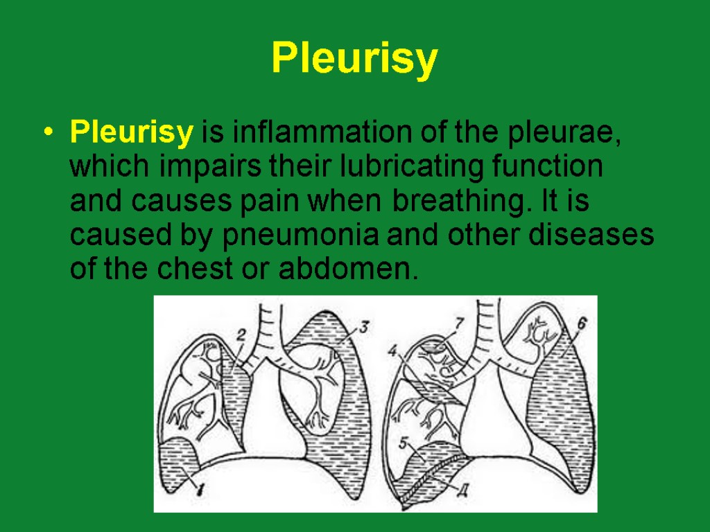 Pleurisy Pleurisy is inflammation of the pleurae, which impairs their lubricating function and causes